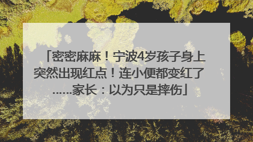 密密麻麻！宁波4岁孩子身上突然出现红点！连小便都变红了……家长：以为只是摔伤